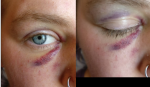 eyebruise.png