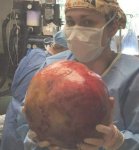 Granulosa Theca Cell Tumour.jpg