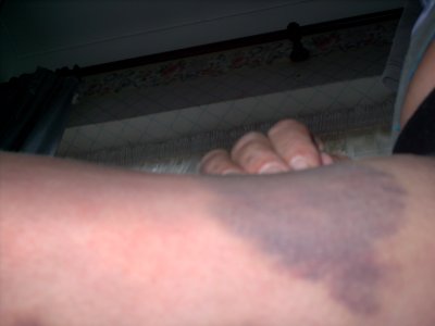 my accident off Biscuit 008.jpg